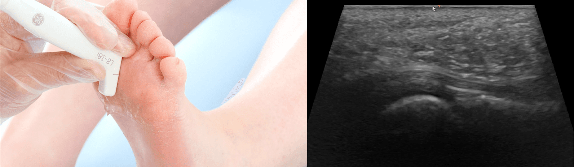 Foot in Focus: Advanced MSK Ultrasound Techniques for Metatarsalgia
