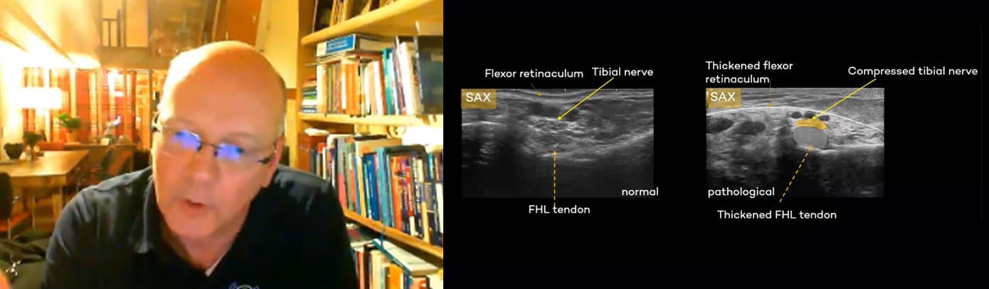 Heel Pain, Diagnosis by Ultrasound