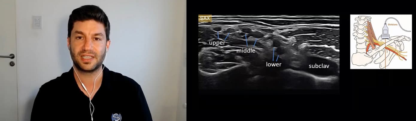 Hydrodissection of Peripheral Nerve Entrapments