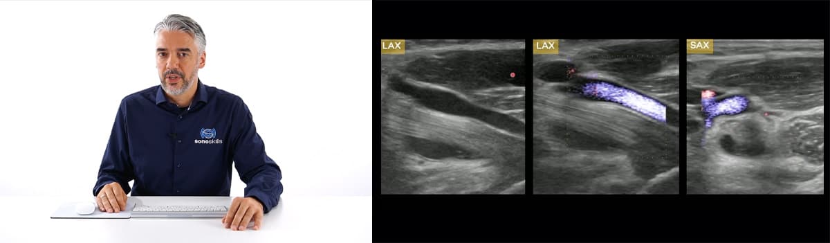 The 8-Step Distal Biceps Tendon Ultrasound Protocol