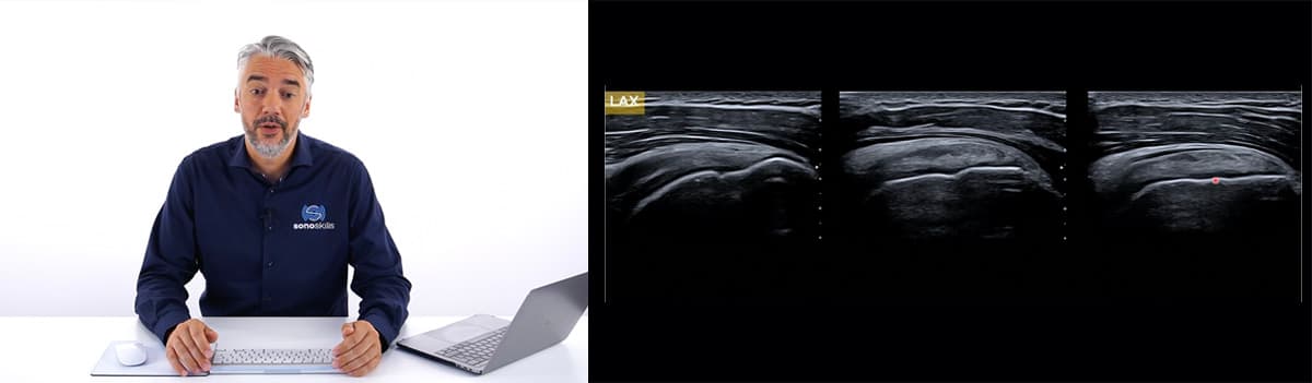 Diagnostic and Interventional MSK Ultrasound Of Subacromial Pain Syndrome