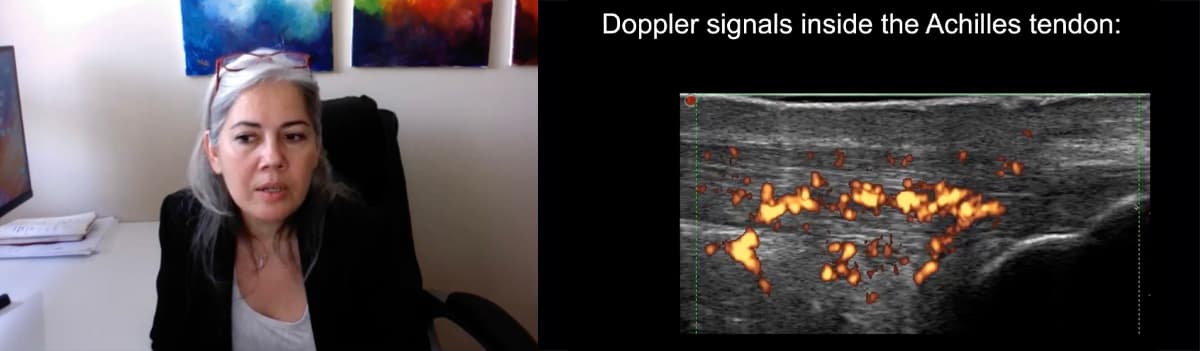 MSK Ultrasound in Psoriatic Arthritis