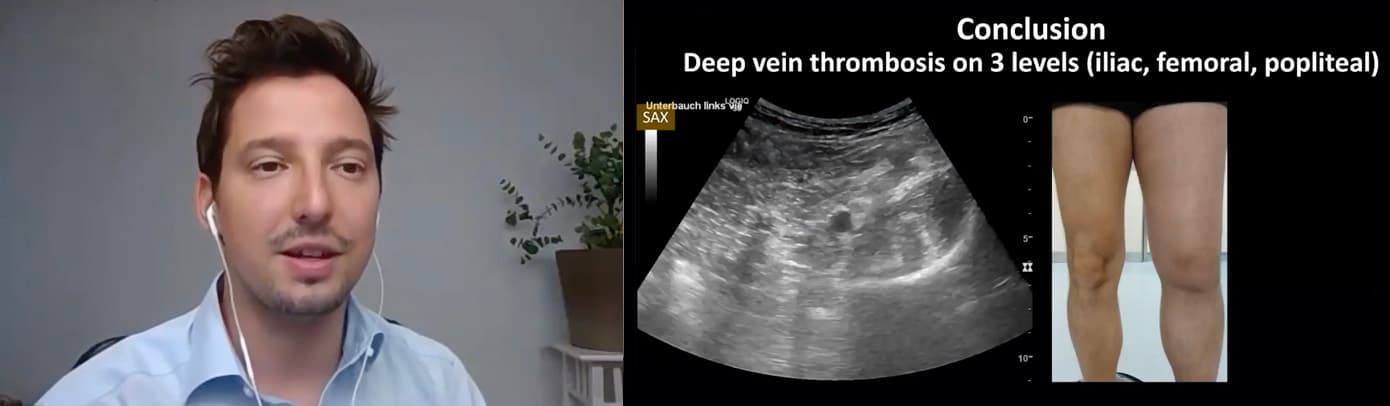 MSK Ultrasound of Muscles in Trauma