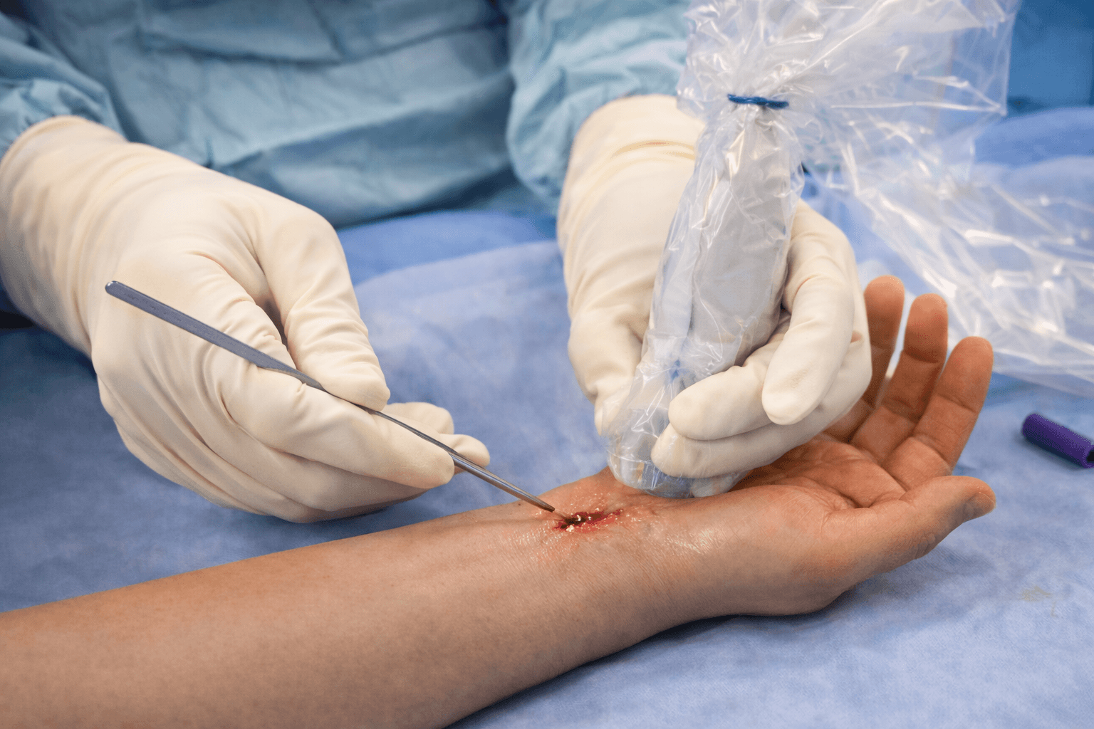 Needle, Knife & Probe: Ultrasound-Guided Procedures of Elbow, Wrist and Hand