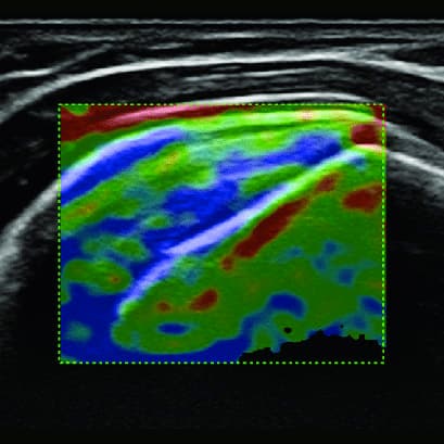 Elastography in MSK Ultrasound