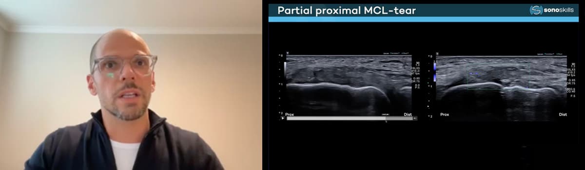 Ultrasound-guided Interventions of Ligaments, Tendons and Joints in Sports Medicine