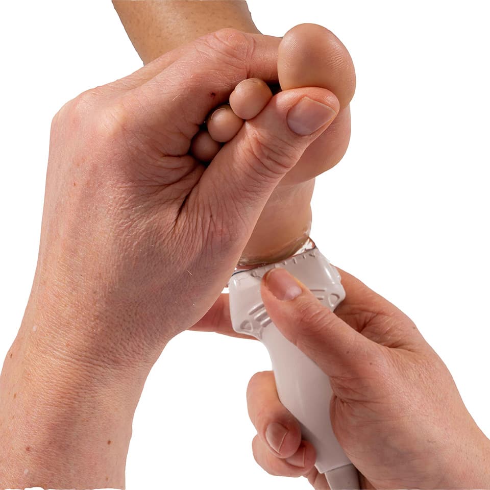 Heel Pain, Diagnosis by Ultrasound