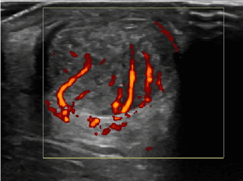 Managing Tendinopathy: the use of ultrasound