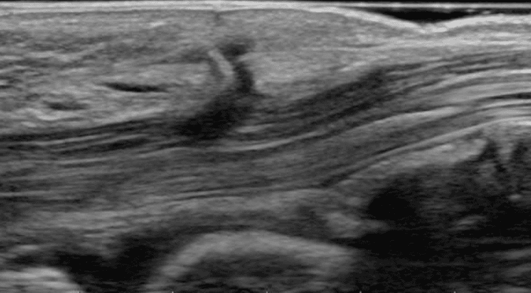 Ultrasound of Traumatic and Iatrogenic Nerve Injuries