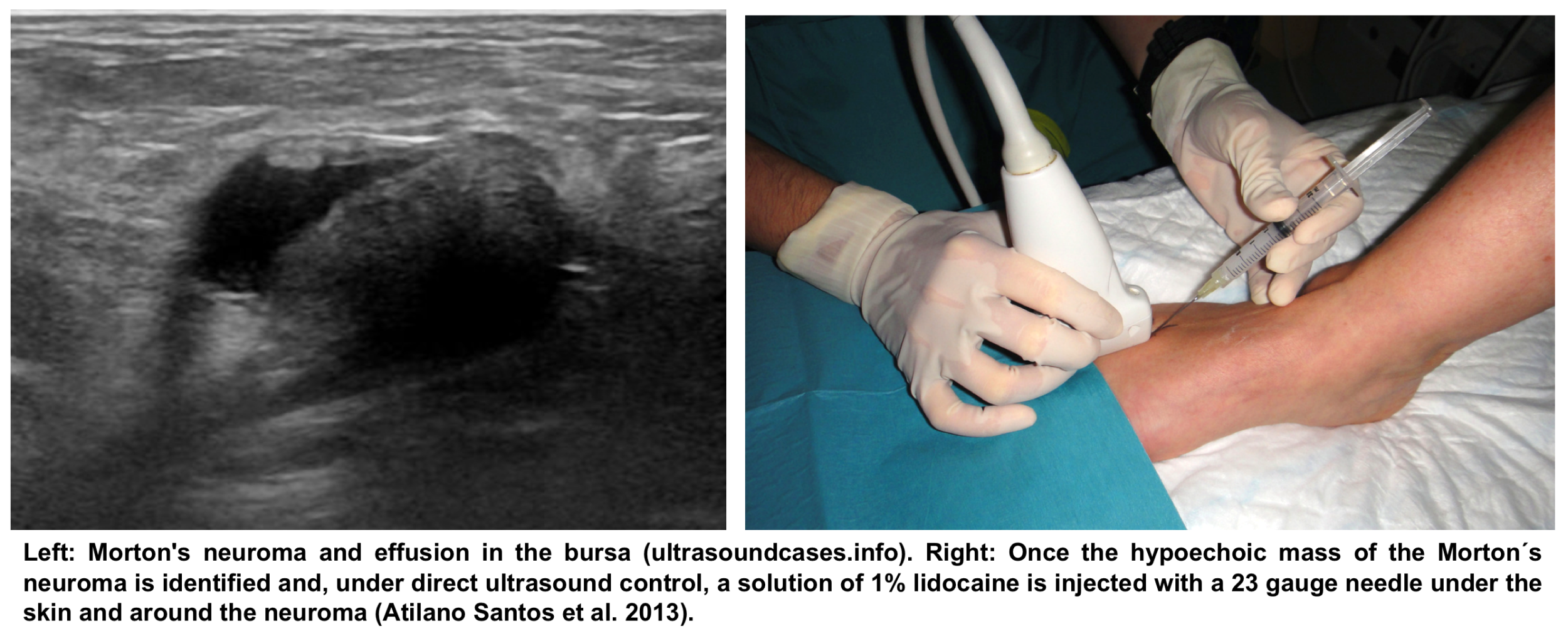Ultrasound guided injection of Morton's neuroma — SonoSkills