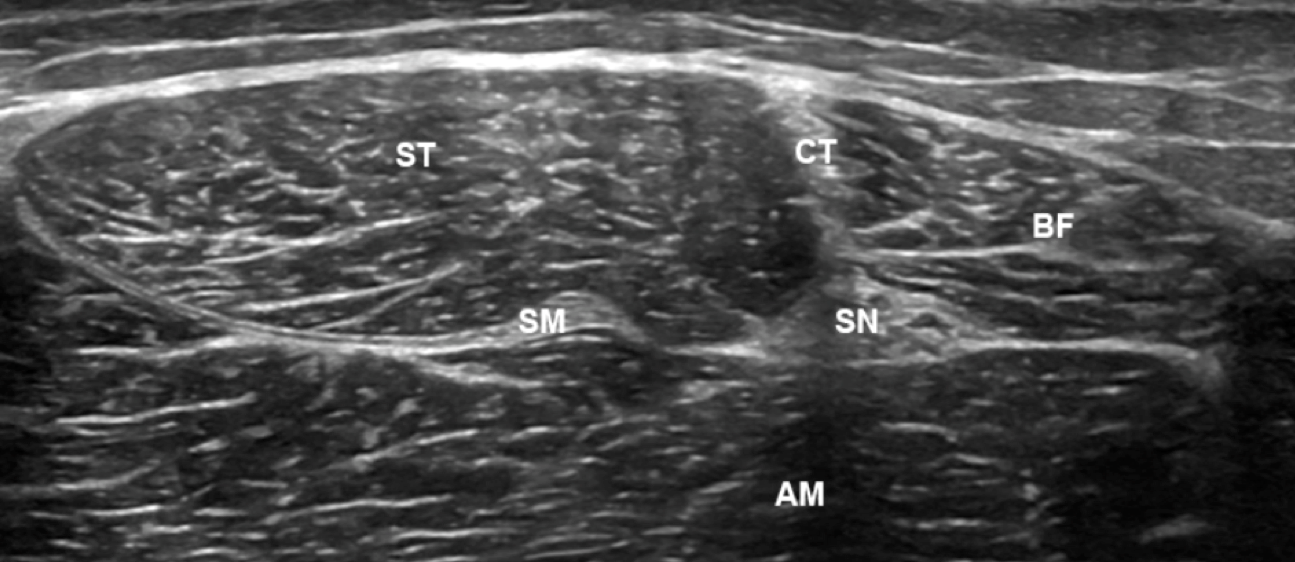 Using ultrasound elastography to quantify sciatic nerve displacement