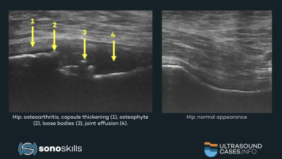 Musculoskeletal ultrasound of the hip joint, soft tissues and nerves