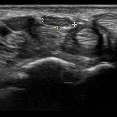 Foundations of Nerve Ultrasound (online) – Level 1