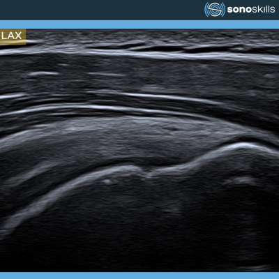 Pain after shoulder surgery:  Ultrasound's role in assessing rotator cuff repair and biceps surgery