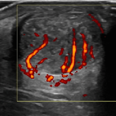 Managing Tendinopathy: the use of ultrasound