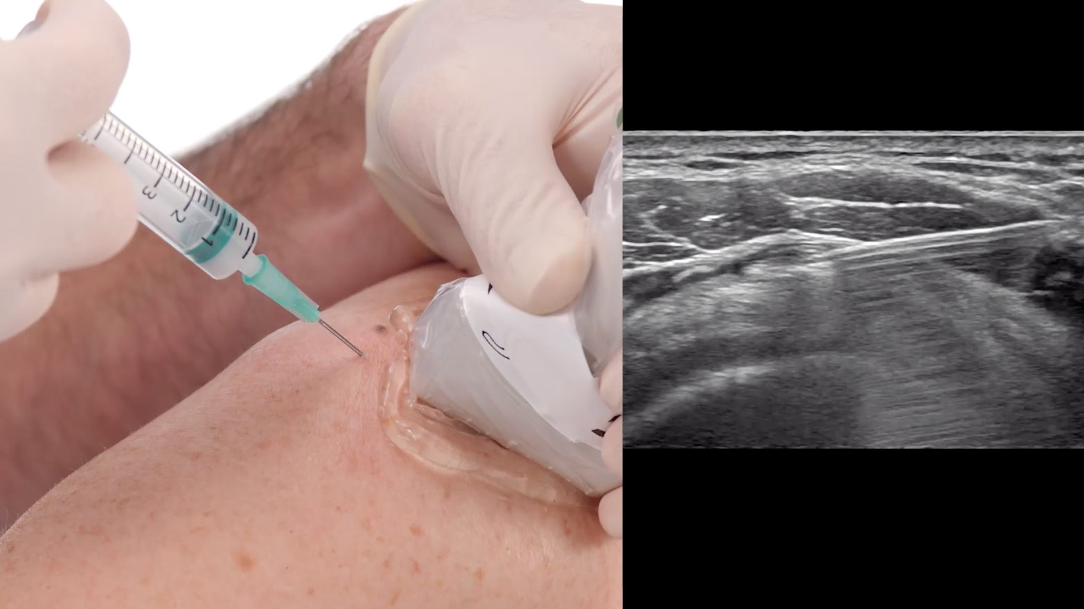 Ultrasound-Guided Injection for Pain Relief